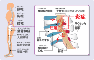 脊柱管狭窄症による足と脚の合併症