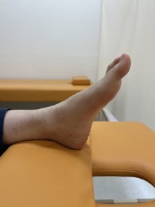 足底腱膜炎の様子